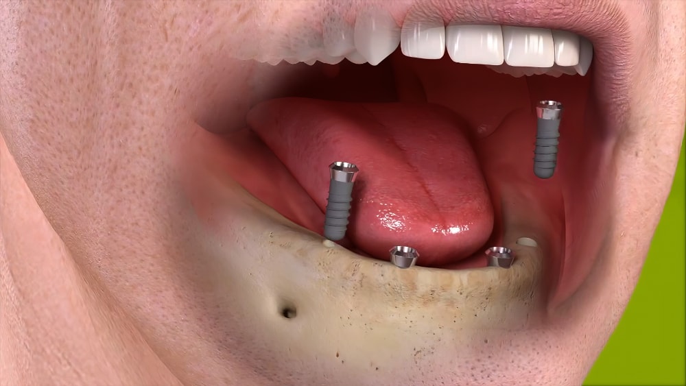 Dentiste cudrefin Implants dentaires