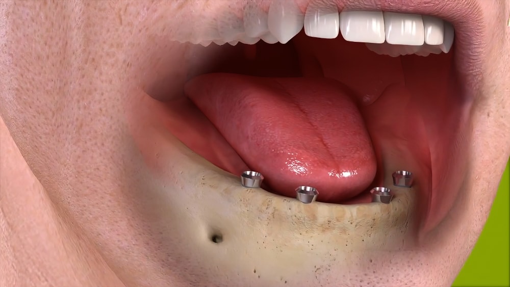 Dentiste cudrefin Prothese amovible attachement retentif