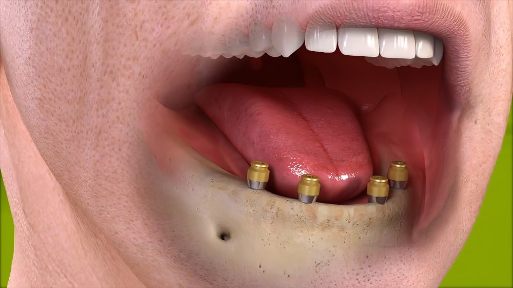 Dentiste Sugiez Implantologie dentaire