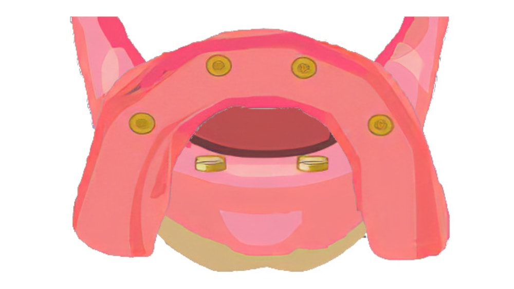 dentiste Sugiez Prothese amovible attachement retentif